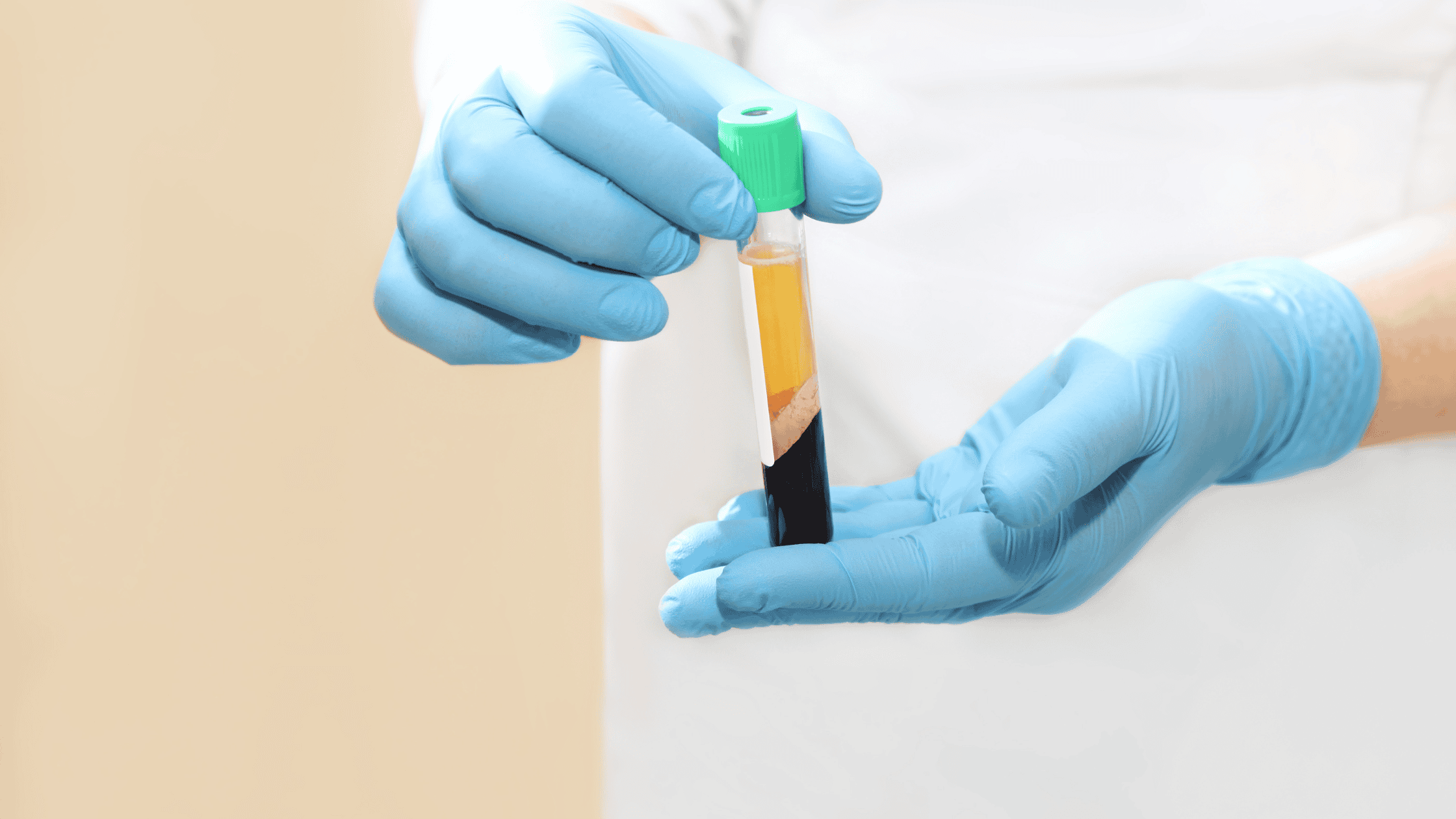 PRP therapy
